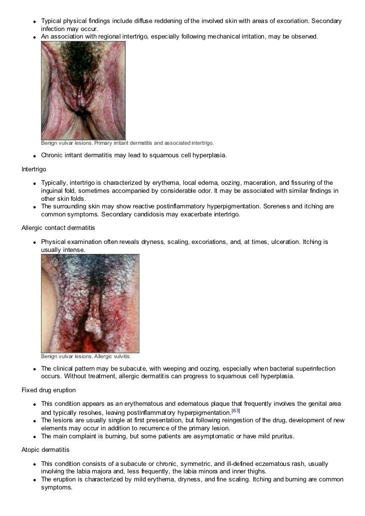 Squamous cell vulva lesion Queeny love bukkake